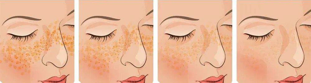 glutathione skin whitening